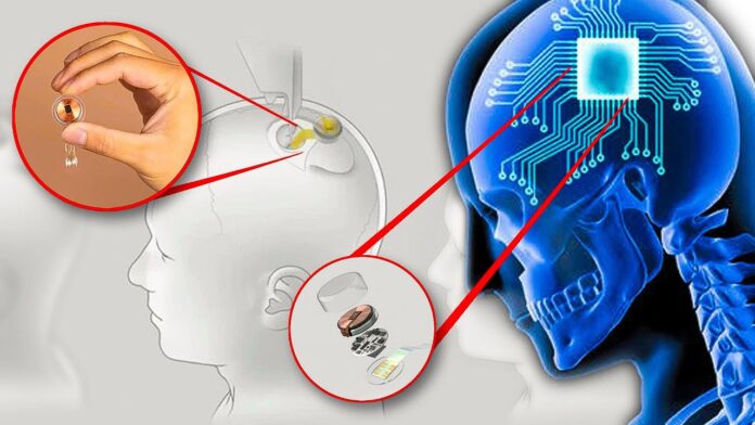 Elon Musk egyik cége, a Neuralink emberi tesztekre keres önkénteseket agyi chip implantálására